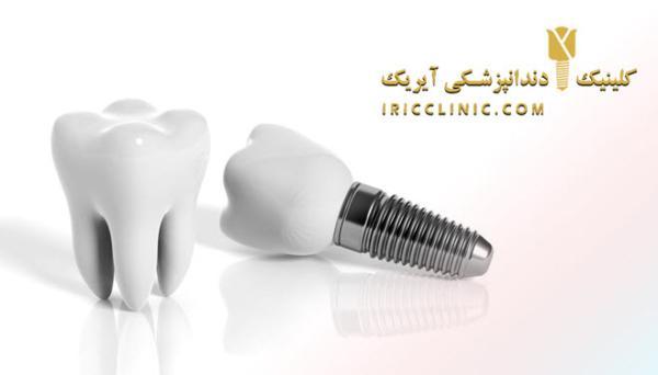 هزینه ایمپلنت دندان در سال تازه چقدر است؟